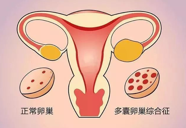 30岁多囊卵巢做试管婴儿成功率高吗？