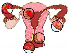 如何进行子宫粘连的手术？子宫粘连的手术中应注意什么？