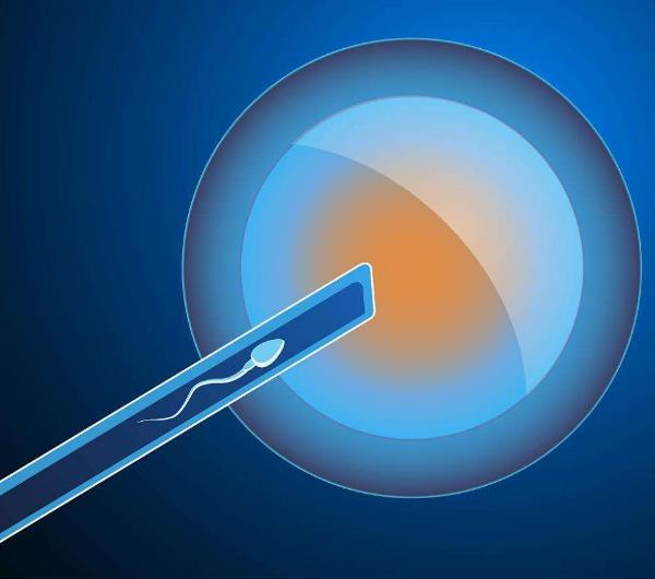 郑州第一人民医院试管成功率-子宫内膜息肉是否影响美国试管婴儿的成功率？