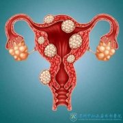 <b>杭州助孕机构嘉aa69行不行-什么是卵巢囊肿，它们是否影响试管婴儿的成功率？</b>